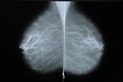 Mammograms pick up swelling due to Covid-19 vaccine, causing unnecessary fear, radiologists say