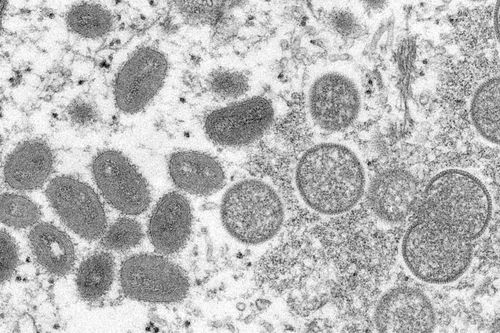 CDC monitors 6 people in US for possible rare monkeypox, says public 'should not be concerned' - Vimarsana News