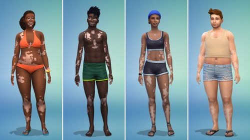 Have vitiligo? Your Sim can have it, too - Vimarsana News
